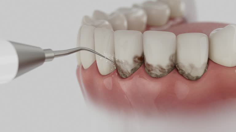 Trusted Wisdom Tooth Removal service in Ironton, MO - Dentist Open Now